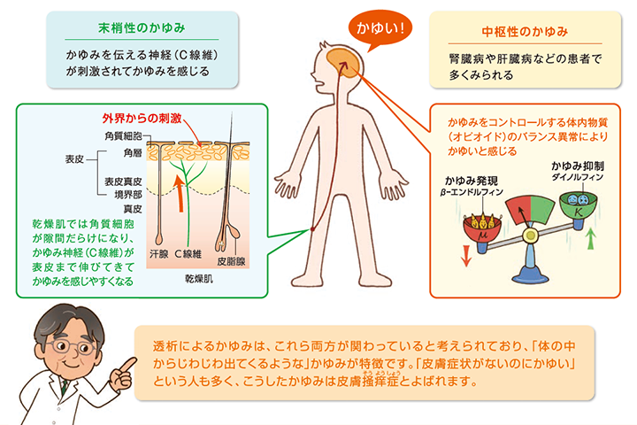 透析のかゆみワンポイントレッスン 透析のかゆみ Jp 鳥居薬品株式会社